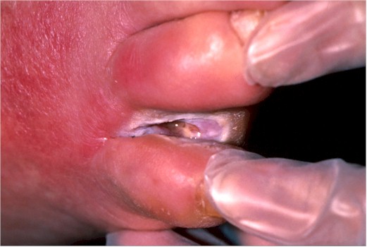 Interdigital ulcer