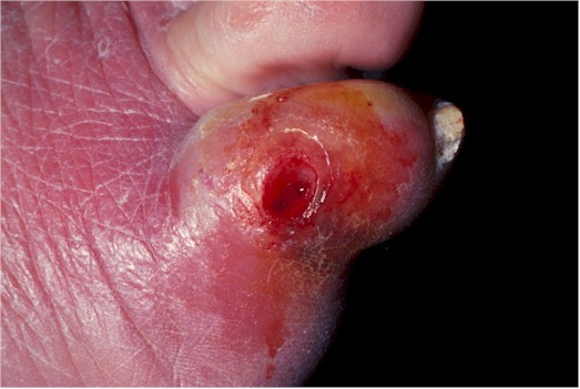 Infected corn