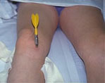 10 year old Penetrating Leg Injury